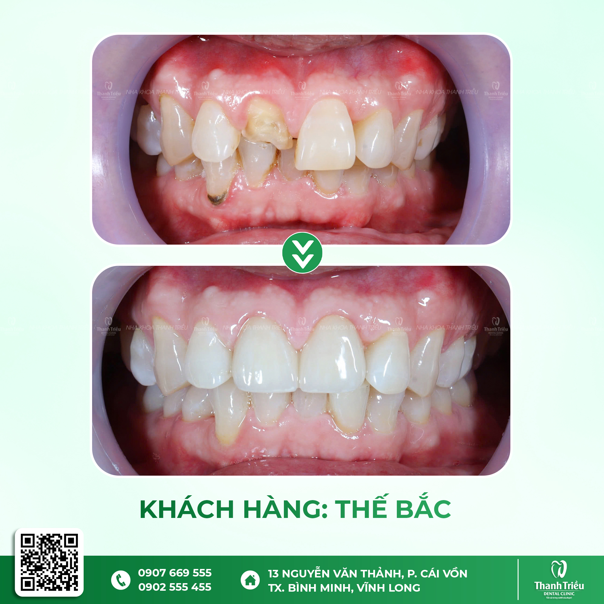 Chú Bắc Lấy Lại Phong Độ Với Răng Sứ Thẩm Mỹ Tại Nha Khoa Thanh Triều