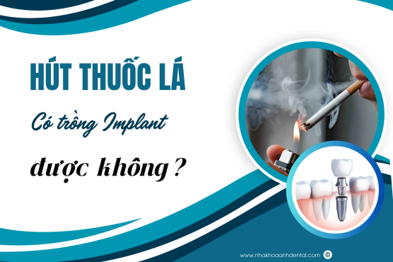 Có thể trồng răng Implant cho người hút thuốc lá? Cần lưu ý gì?