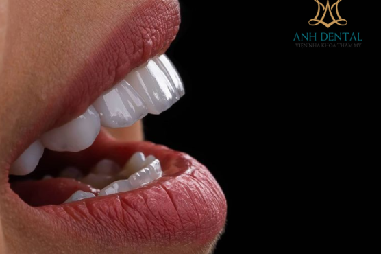 So sánh các loại vật liệu làm răng sứ phổ biến hiện nay: Ưu và nhược điểm từng loại