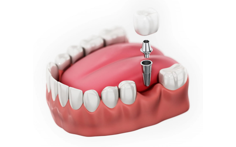 Trồng răng Implant - Mất răng lẻ