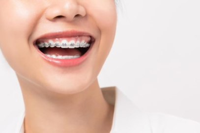 Niềng răng một hàm: Ai phù hợp? Lợi ích và những điều quan trọng cần biết